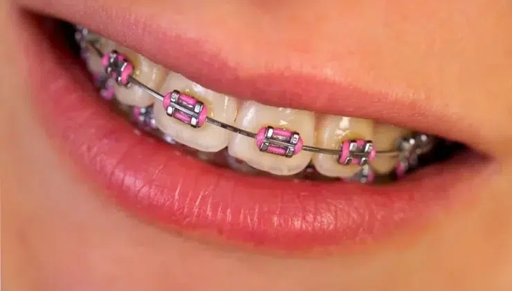 Metal Braces