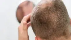 Hair Loss