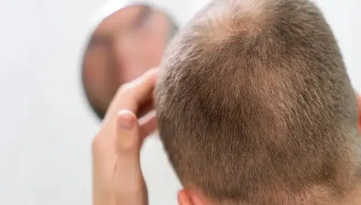Hair Loss
