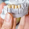 Dental Bridge