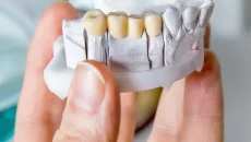 Dental Bridge
