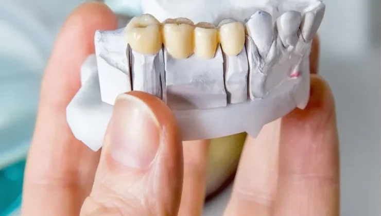 Dental Bridge