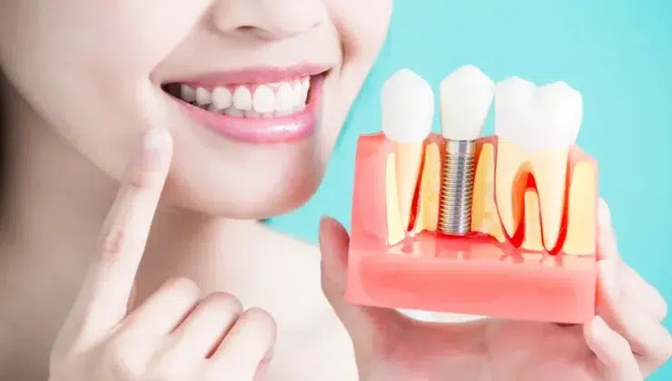 Dental Implants