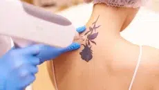 Tattoo Without Scarring