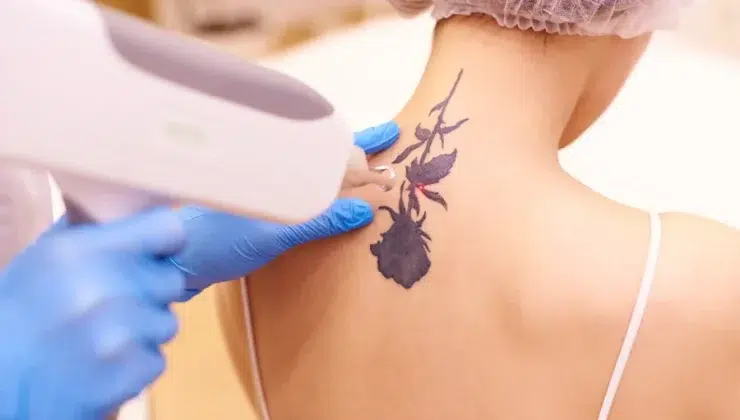 Tattoo Without Scarring