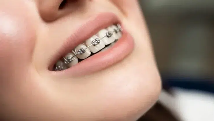 Why More People Are Skipping Braces and Choosing Bonding Instead