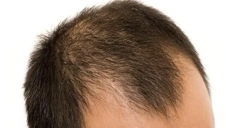 Changes in Male Hair What They Might Mean for You
