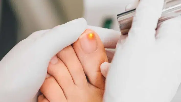 Toenail Fungus