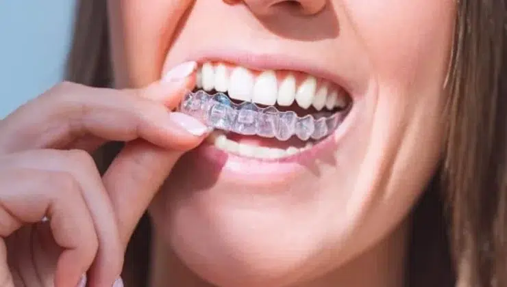 Aligners The Clear Path to a Straighter Smile