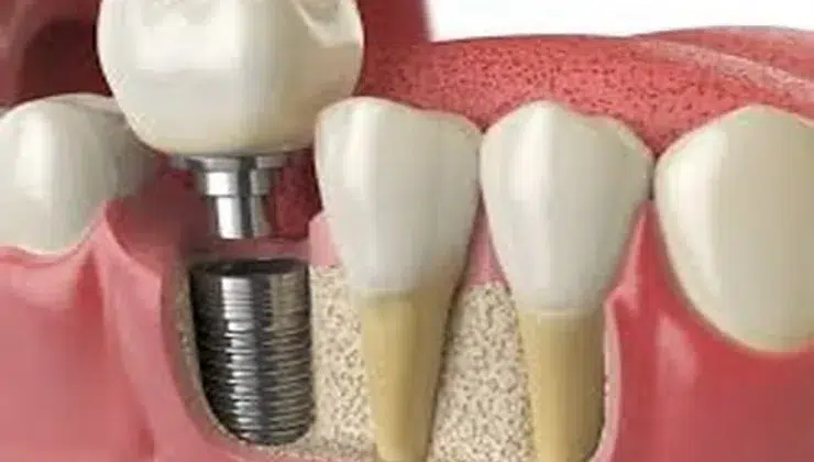 Dental Implant Treatment