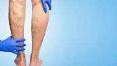 Varicose Veins