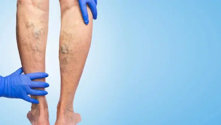 Varicose Veins