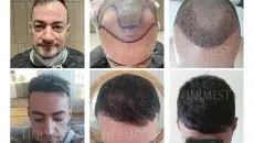 The Ultimate 2026 Guide Best Hair Transplants in Turkey for Texas Patients