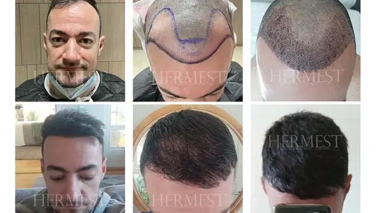 The Ultimate 2026 Guide Best Hair Transplants in Turkey for Texas Patients