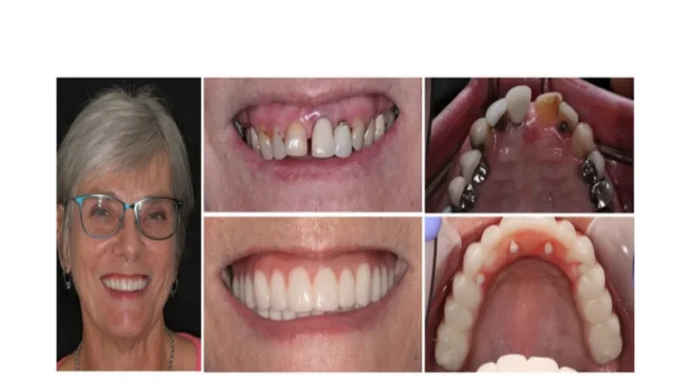 All-on-4 Dental Implants
