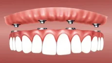 Dentures