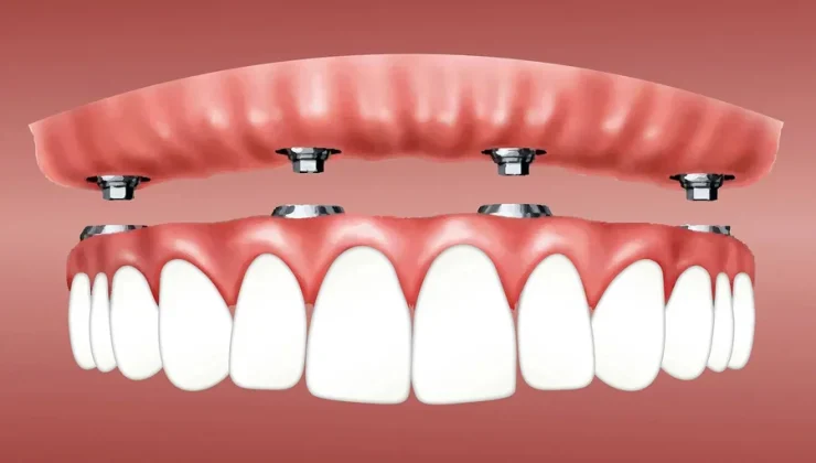 Dentures