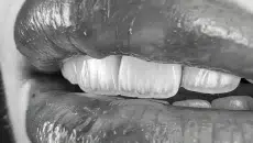 Porcelain Veneers in 2026 What You Need to Know Before Committing