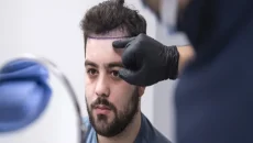 Hair Transplants