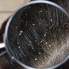 Dandruff