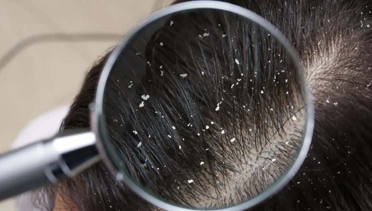 Dandruff