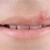 Aciclovir