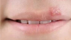 Aciclovir
